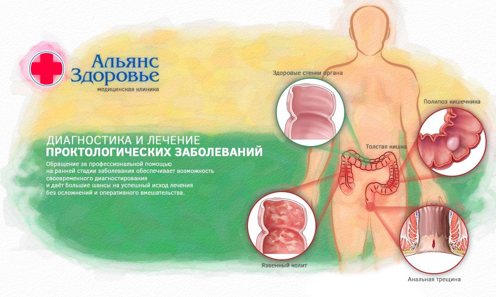 Диагностика и лечение проктологических заболеваний в Перми